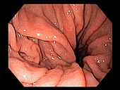 Hiatal hernia, endoscope view
