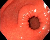 Healthy antrum of the stomach, endoscope view