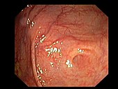 Caecum-appendix aperture, endoscopic view