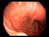 Healthy rectum, endoscope view
