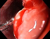 Oesophageal cancer, endoscope view