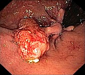 Anal polyp, endoscope view
