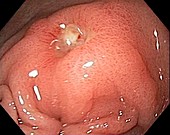 Prepyloric stomach ulcer, endoscopic view