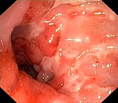 Crohn's disease, endoscopic view
