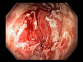 Ulcerative colitis, endoscope view