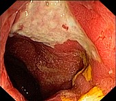 Pouchitis and ulcerative colitis, endoscope view