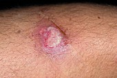 Cutaneous leishmaniasis lesion