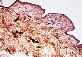 Mycosis fungoides, light micrograph