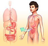 Gastric bypass, illustration