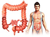 Diverticulosis disease, illustration
