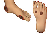 Diabetic foot ulcers, illustration