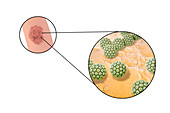 Penile warts and human papilloma virus, illustration