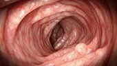 Adenomatous polyp, animation