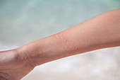 Jellyfish sting