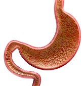 Cancer of the small intestine, illustration