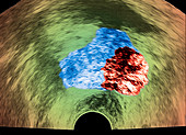 Cancer prostate, ultrasound scan