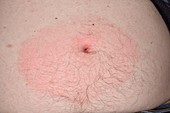 Cellulitis in tick bite
