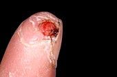 Finger wound in chemotherapy