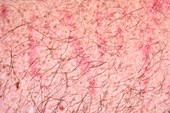 Dermatographic vascular urticaria