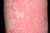 Urticaria in respiratory infection