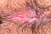 Fissure in perianal dermatitis