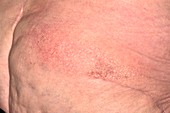 Dermatitis following shingles infection