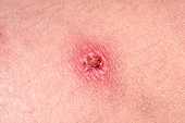 Infected eczema rash