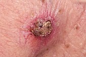 Ulcerated solar keratosis