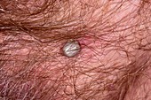 Tick on scrotum