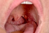 Tonsil cyst