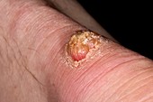 Bowenoid keratosis