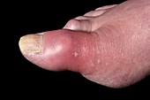 Swollen foot in gout