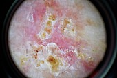 Basal cell carcinoma skin cancer, dermoscopy image