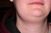 Swollen lymph glands in neck