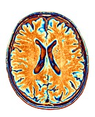 MRI Brain scan of the human head