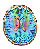 Brain MRI and white matter fibres