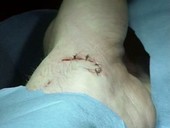 Patient having stitches