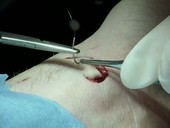 Patient having stitches