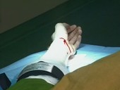 Anaesthetic injection in wrist