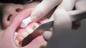 Fitting dental braces