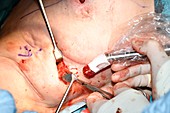 Breast cancer surgery using gamma camera