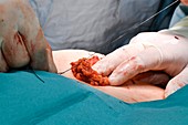 Excised tumour in breast cancer surgery