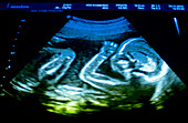 Ultrasound of 20 week old foetus