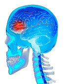 Brain haemorrhage, illustration