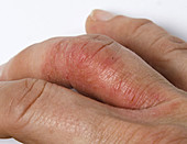 Psoriatic Arthritis on Hand