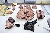 Brain trauma forensics specimen