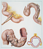 Meckel's diverticulum of the small intestine, illustration