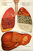 Lung and liver diseases, 19th Century illustration