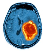 Brain tumour