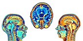 MRI scans of normal brains, artwork